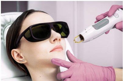 Un’immagine che mostra il prima e dopo di un trattamento laser per l’acne attiva, evidenziando la riduzione delle lesioni cutanee.