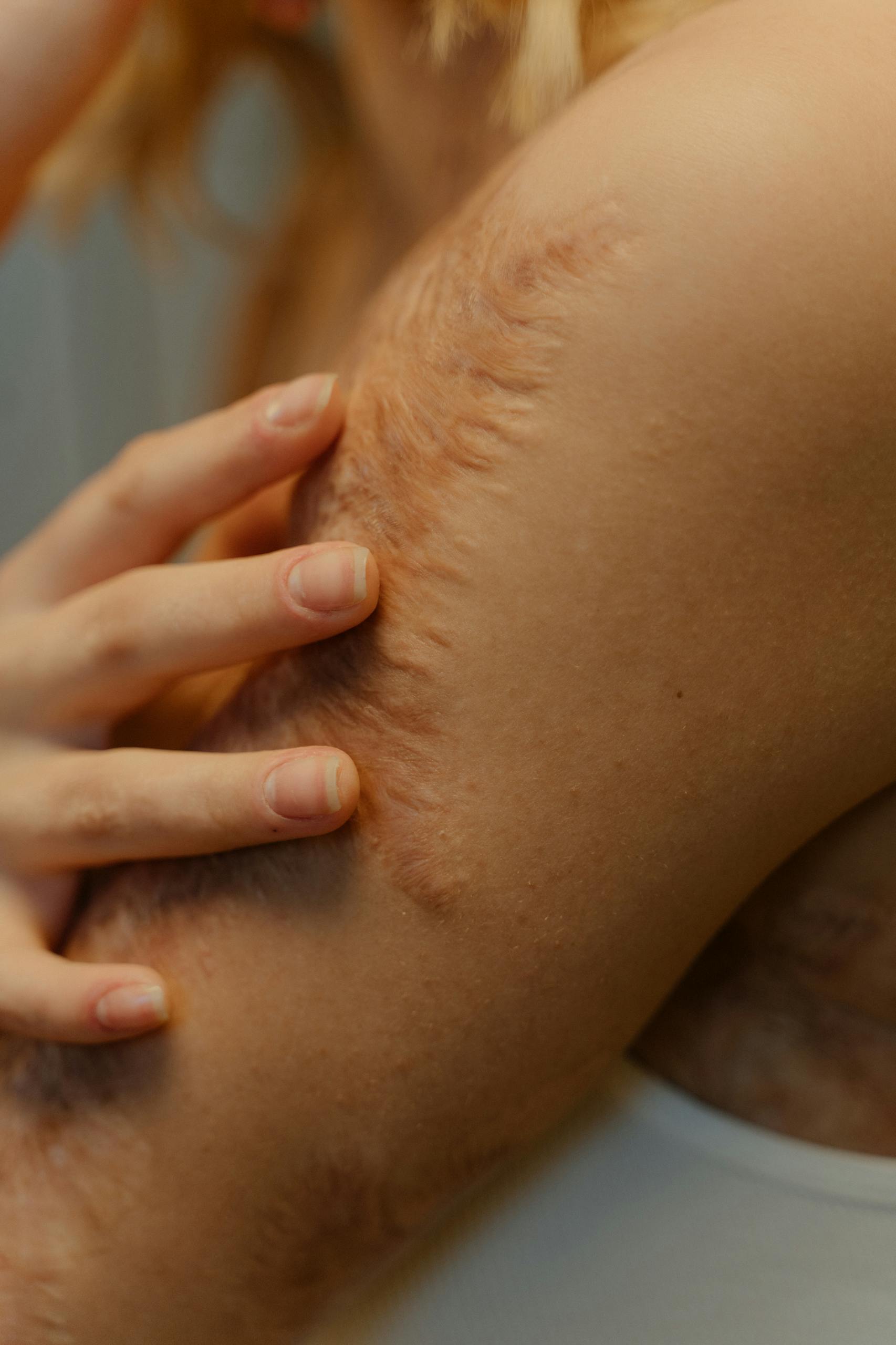 Visione ravvicinata di una cicatrice naturale sul braccio, simbolo di rigenerazione cutanea